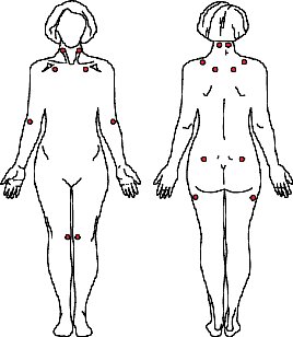 Fibromyalgia tender points from the National Institute of Arthritis and Musculoskeletal and Skin Diseases